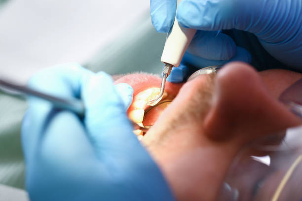 Best Emergency Dental Extractions in Lemoyne, PA